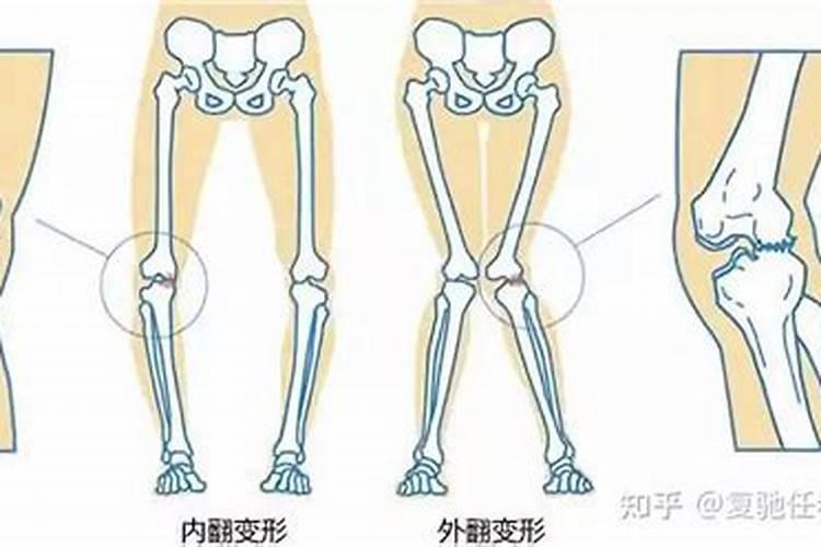 内八字会自然恢复吗