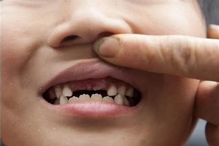 病人梦见掉牙齿是什么征兆