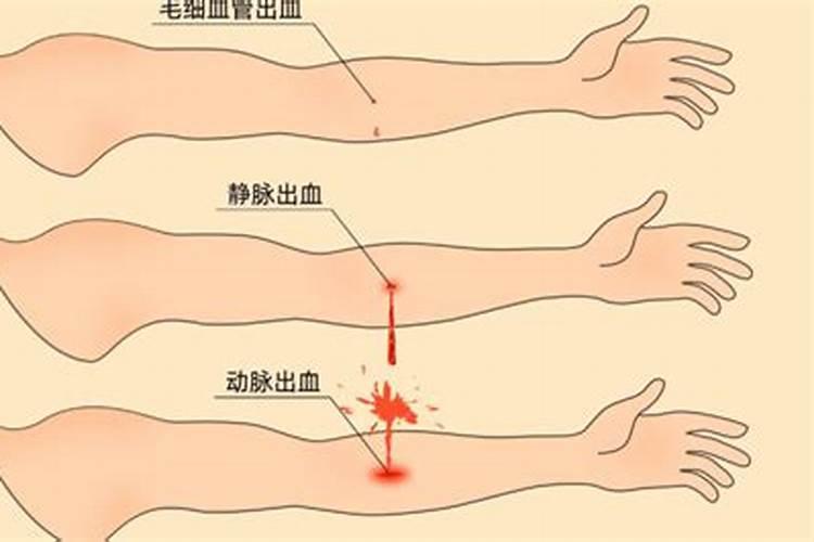 梦见动脉血管受伤喷血